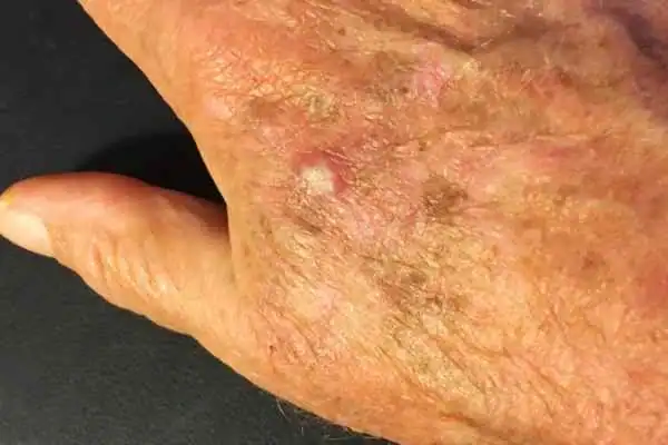 CryoPen for Actinic Keratoses 1 Image of Actinic keratoses Woodham Ferrers on a person hand
